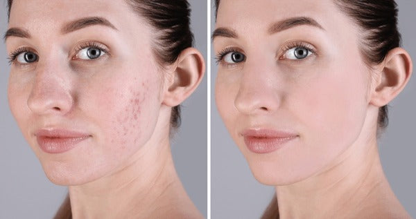 La Roche-Posay – Cicaplast Baume B5+
